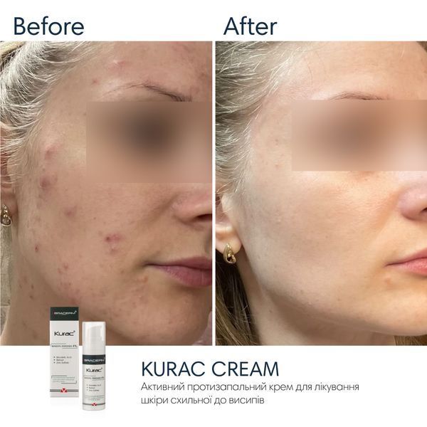 Нічний крем з бензоїл пероксидом Braderm Kurac Cream, 30мл 0424 фото