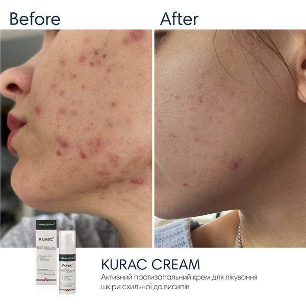 Нічний крем з бензоїл пероксидом Braderm Kurac Cream, 30мл 0424 фото