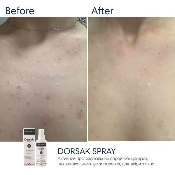 Спрей-концентрат для тіла з бензоїл пероксидом Braderm Dorsak Spray, 100 мл 0425 фото