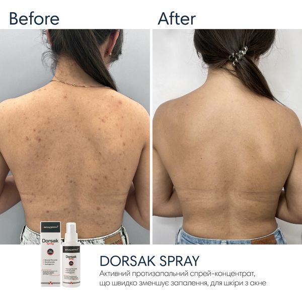 Спрей-концентрат для тіла з бензоїл пероксидом Braderm Dorsak Spray, 100 мл 0425 фото