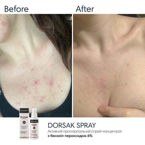 Спрей-концентрат для тіла з бензоїл пероксидом Braderm Dorsak Spray, 100 мл 0425 фото